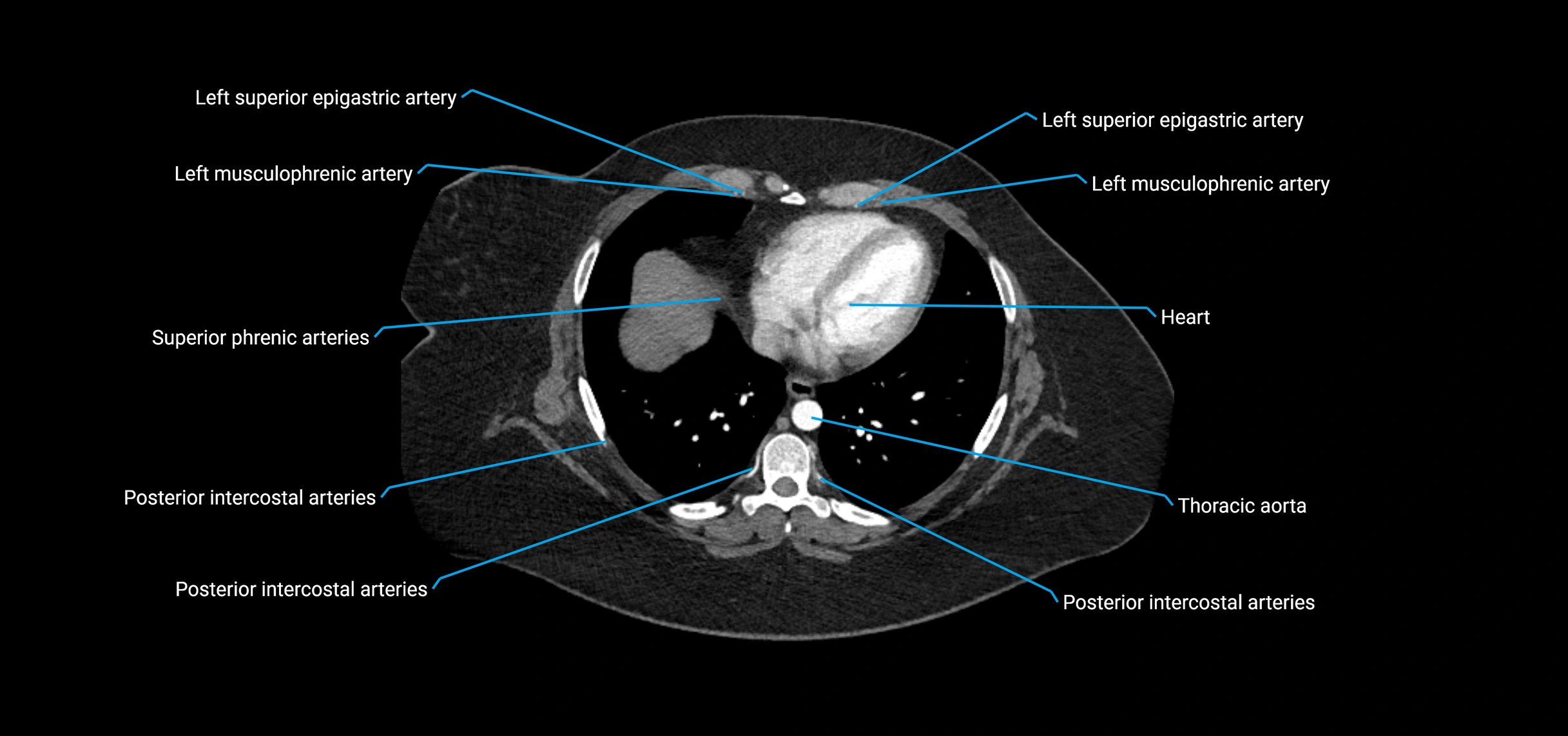 CTA abdomen axial cross sectional anatomy labelled image_7 (1).webp